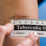 В Україні «замінять» пробу Манту на новий тест