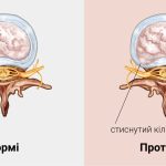 Види протрузій та їх лікування